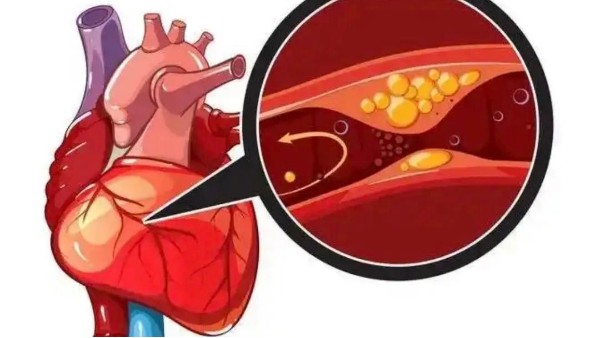 真實(shí)案例：是什么讓他堅(jiān)持一年，冠狀動(dòng)脈堵塞消除30%！