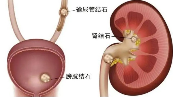 重用、活用水蛭治療尿路結(jié)石，療效較好