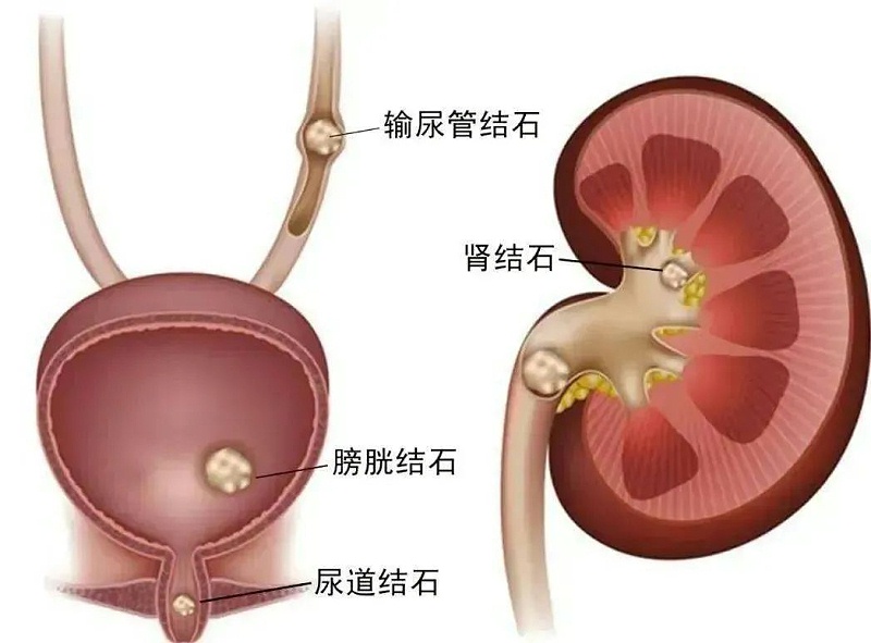 水蛭素、尿路結石、腎功能