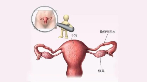 水蛭有利水道、破積聚之功，可用于治療輸卵管積水