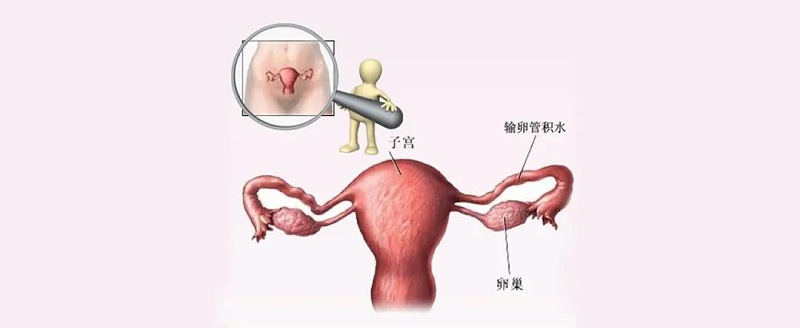 水蛭素、輸卵管積水、不孕不育