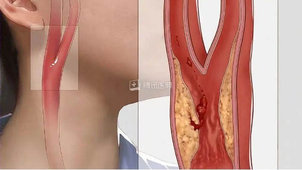 真實(shí)案例丨3個(gè)月左頸動(dòng)脈狹窄降低約27%，是怎么實(shí)現(xiàn)的？