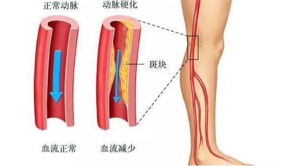 水蛭在改善下肢動(dòng)脈硬化性閉塞癥中發(fā)揮重要療效，安全性及可行性較高