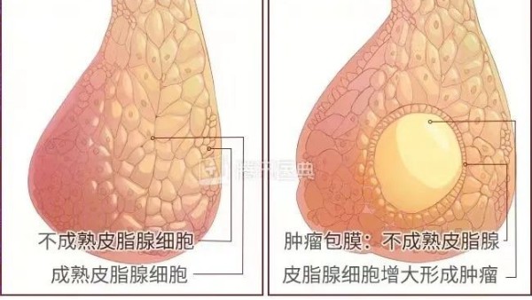 真實(shí)案例 | 腫瘤克星，百姓福音——現(xiàn)代壯醫(yī)水蛭療法