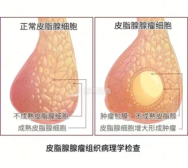 壯醫(yī)水蛭療法，天然水蛭素膠囊