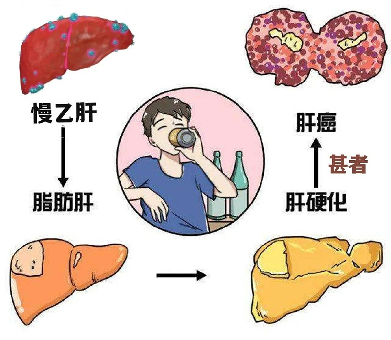 水蛭素、肝硬化、脂肪肝