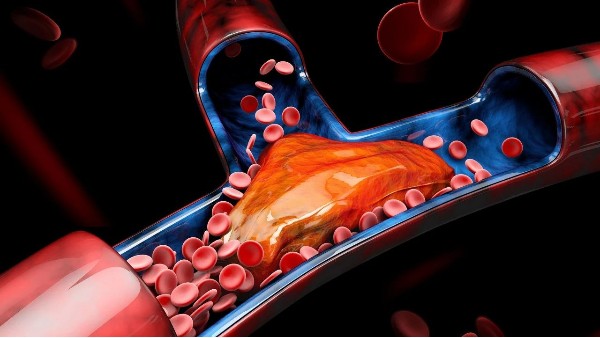 血栓最容易堵在身體3個(gè)地方！有這4個(gè)信號(hào)一定要留意→