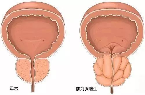 水蛭素、前列腺增生、前列腺肥大