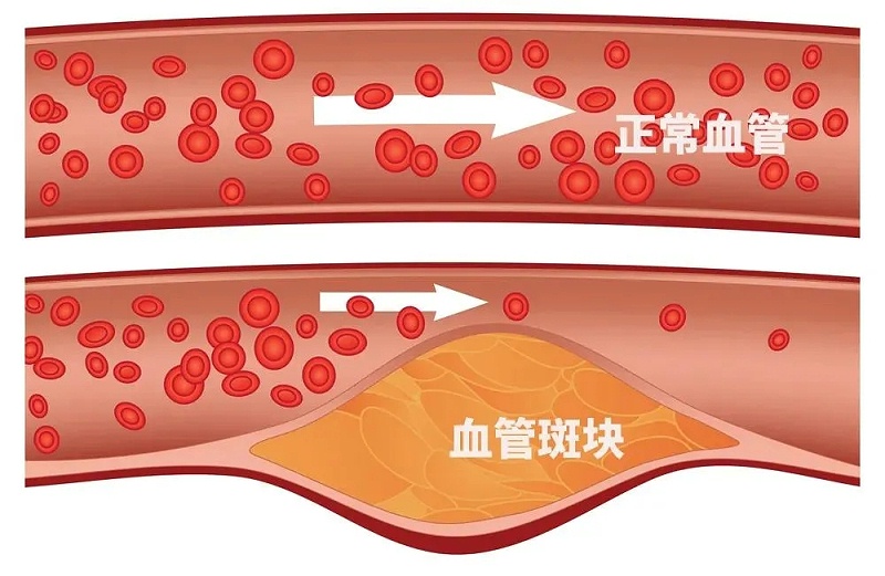 水蛭素、通血管、血管堵塞