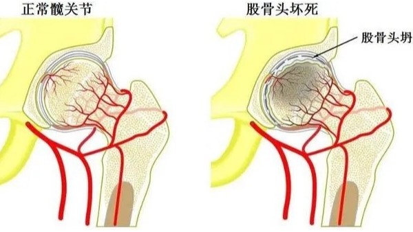 水蛭通脈湯治療股骨頭無菌性壞死效果顯著